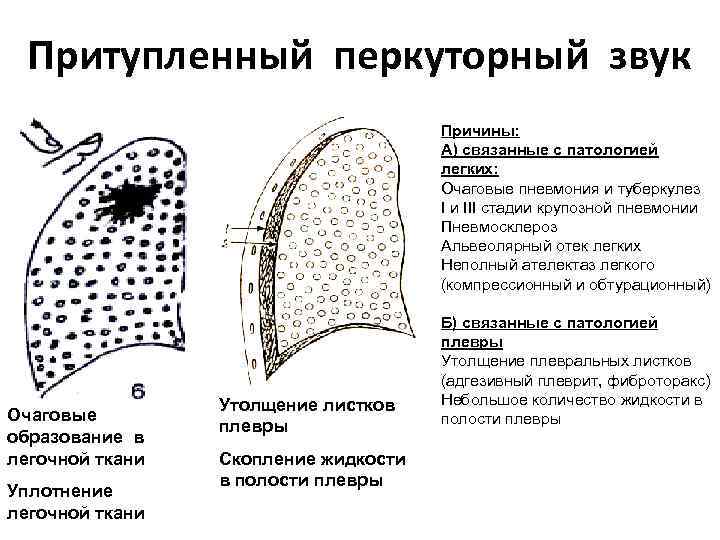 Тон шкоды при перкуссии