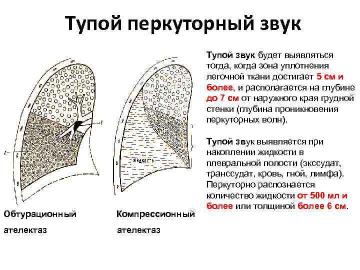 Тупой перкуторный звук Тупой звук будет выявляться тогда, когда зона уплотнения легочной ткани достигает