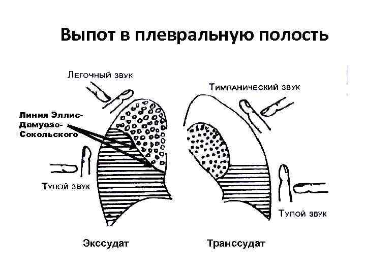 Схема перкуссия легких