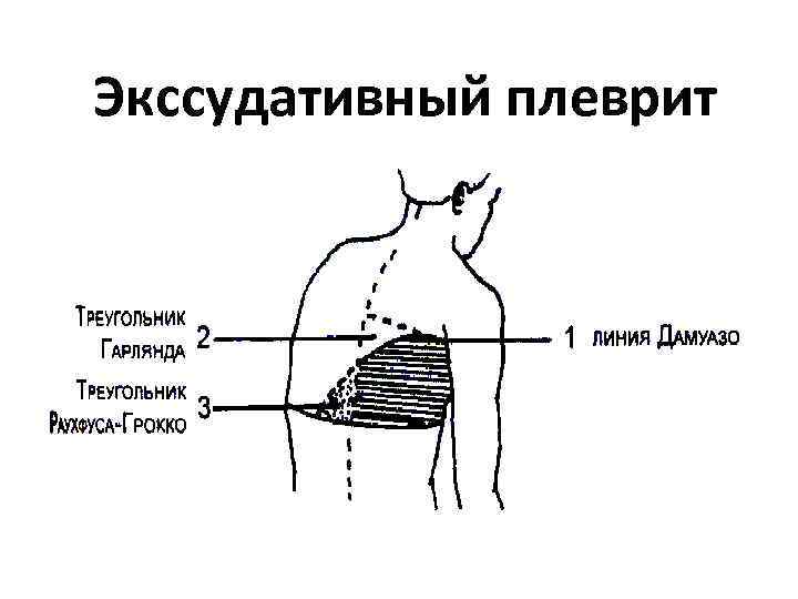 Экссудативный плеврит 