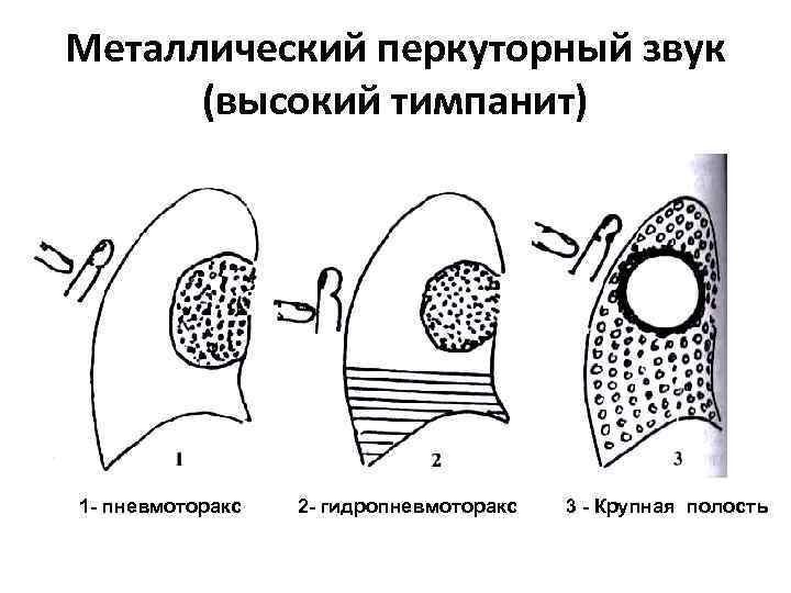 Металлический перкуторный звук (высокий тимпанит) 1 - пневмоторакс 2 - гидропневмоторакс 3 - Крупная