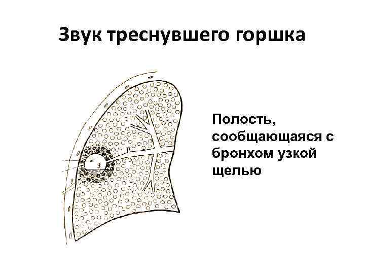 Звук треснувшего горшка Полость, сообщающаяся с бронхом узкой щелью 