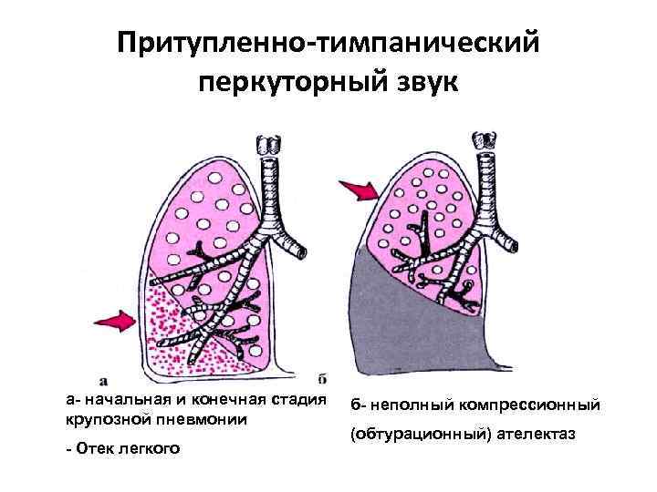 Конечная стадия. Компрессионный ателектаз звук. Тимпанический перкуторный звук. Притупление перкуторного звука. Притупление перкуторного звука в легких.