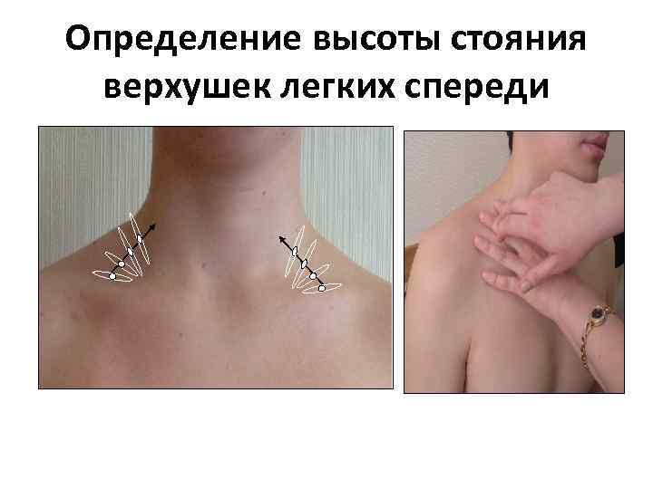 Определение высоты стояния верхушек легких спереди 