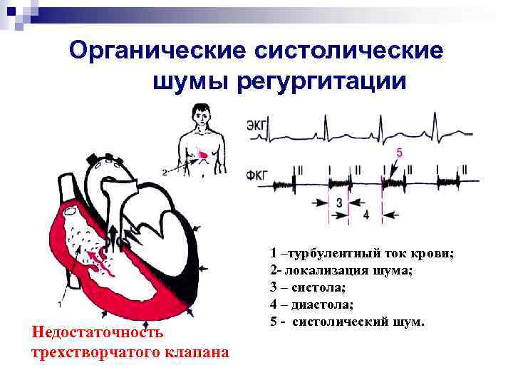 Органические систолические шумы регургитации Недостаточность трехстворчатого клапана 1 –турбулентный ток крови; 2 - локализация