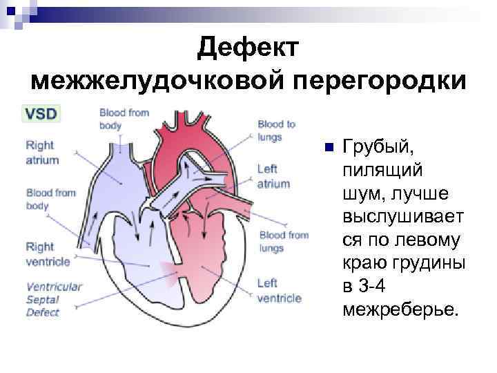 Дефект межжелудочковой перегородки n Грубый, пилящий шум, лучше выслушивает ся по левому краю грудины