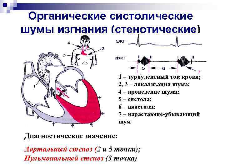 Органические систолические шумы изгнания (стенотические) 1 – турбулентный ток крови; 2, 3 – локализация