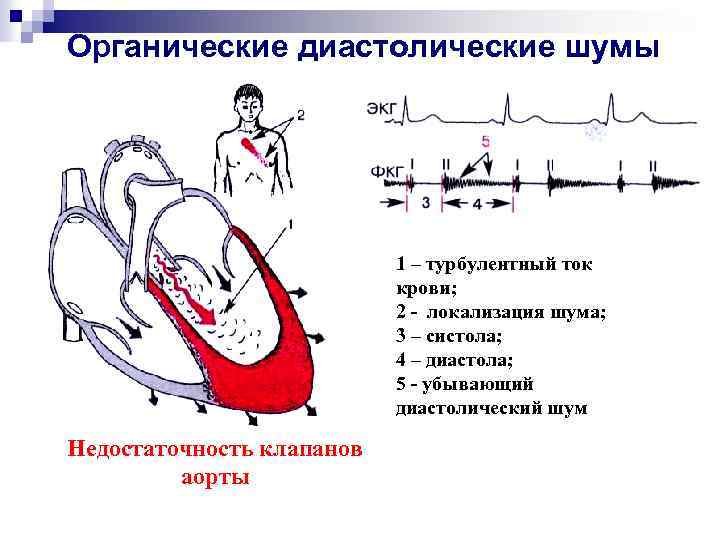 Органические диастолические шумы 1 – турбулентный ток крови; 2 - локализация шума; 3 –