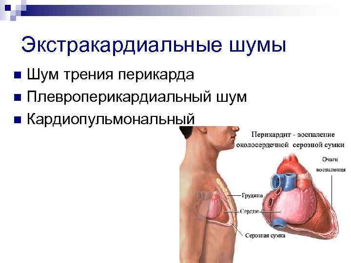 Экстракардиальные шумы Шум трения перикарда n Плевроперикардиальный шум n Кардиопульмональный n 