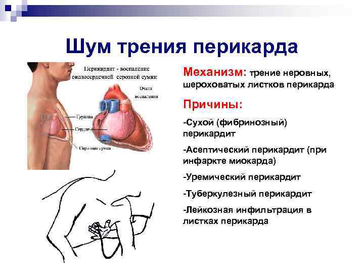 Шум трения перикарда Механизм: трение неровных, шероховатых листков перикарда Причины: -Сухой (фибринозный) перикардит -Асептический