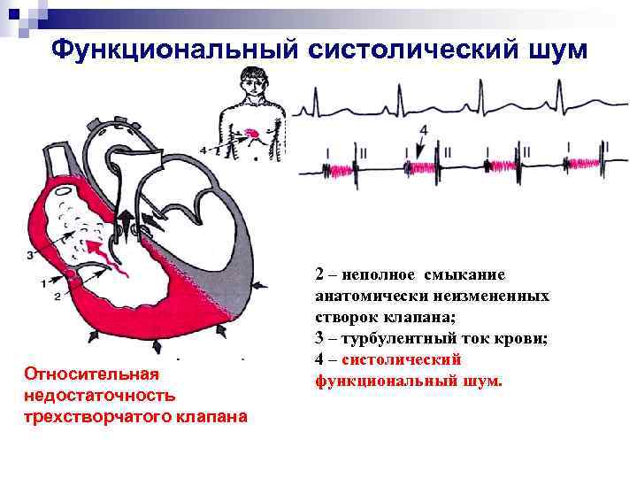 Функциональный систолический шум Относительная недостаточность трехстворчатого клапана 2 – неполное смыкание анатомически неизмененных створок