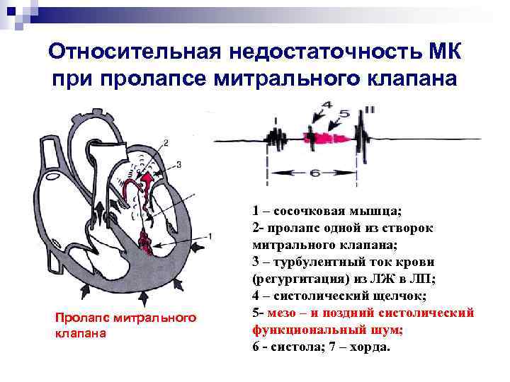 Относительная недостаточность МК при пролапсе митрального клапана Пролапс митрального клапана 1 – сосочковая мышца;