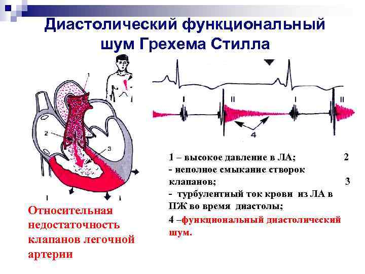 Диастолический функциональный шум Грехема Стилла Относительная недостаточность клапанов легочной артерии 1 – высокое давление