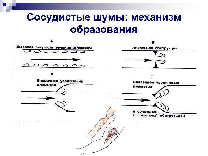 Сосудистые шумы: механизм образования 