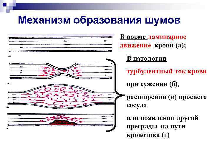 Механизм образования шумов В норме ламинарное движение крови (а); В патологии турбулентный ток крови