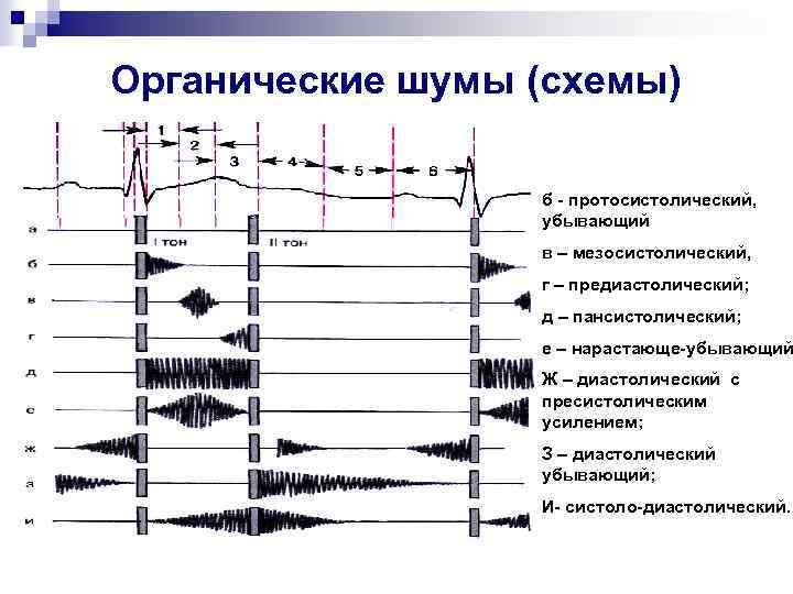 Органические шумы (схемы) б - протосистолический, убывающий в – мезосистолический, г – предиастолический; д