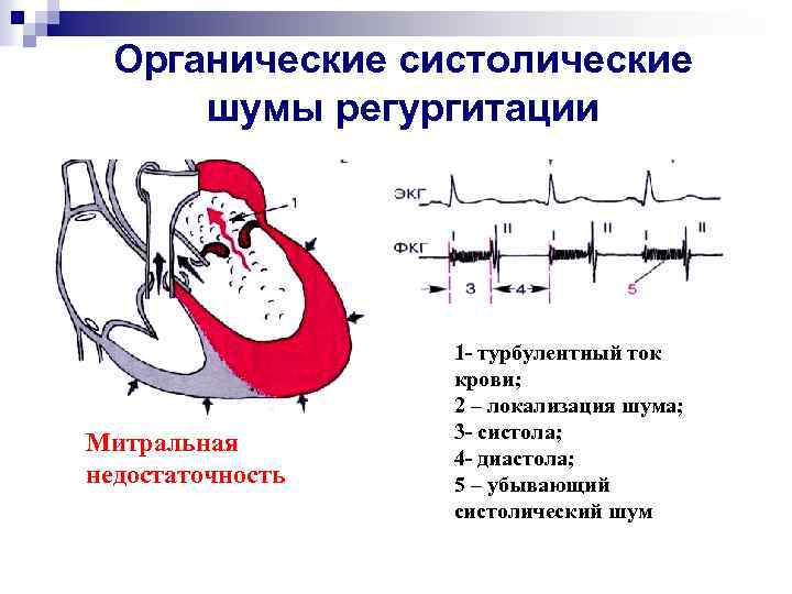 Органические систолические шумы регургитации Митральная недостаточность 1 - турбулентный ток крови; 2 – локализация