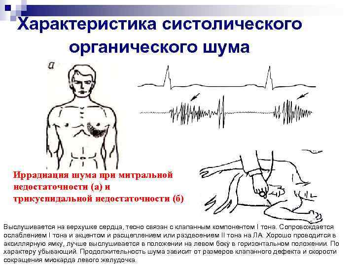 Характеристика систолического органического шума Иррадиация шума при митральной недостаточности (а) и трикуспидальной недостаточности (б)