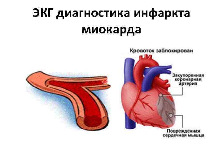 ЭКГ диагностика инфаркта миокарда 
