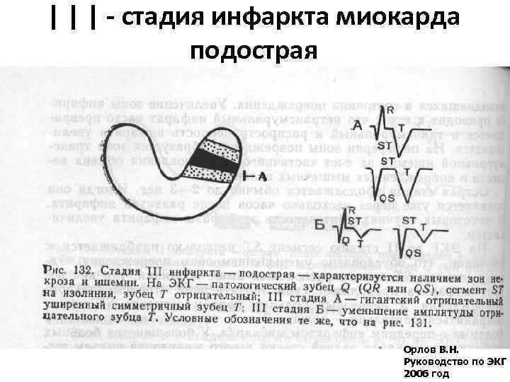 | | | - стадия инфаркта миокарда подострая Орлов В. Н. Руководство по ЭКГ