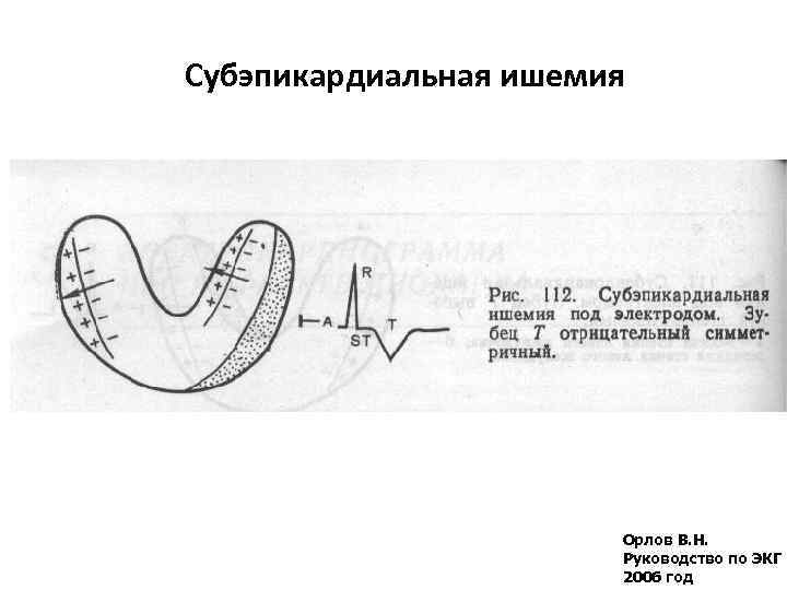 Субэпикардиальная ишемия Орлов В. Н. Руководство по ЭКГ 2006 год 