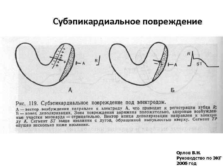 Субэпикардиальное повреждение Орлов В. Н. Руководство по ЭКГ 2006 год 