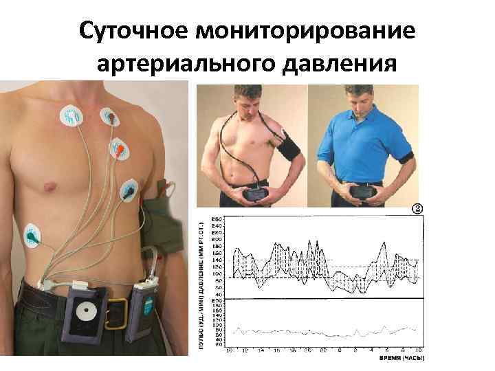 Суточное мониторирование артериального давления 