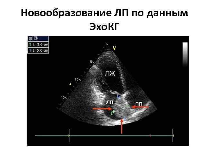 Новообразование ЛП по данным Эхо. КГ 