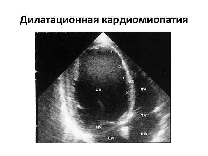 Дилатационная кардиомиопатия 