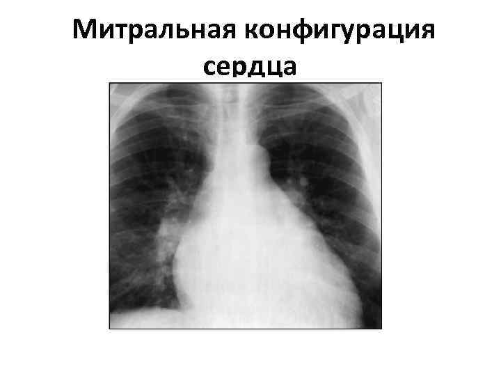  Митральная конфигурация сердца 