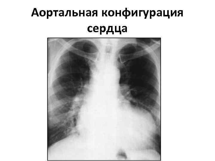 Аортальная конфигурация сердца 