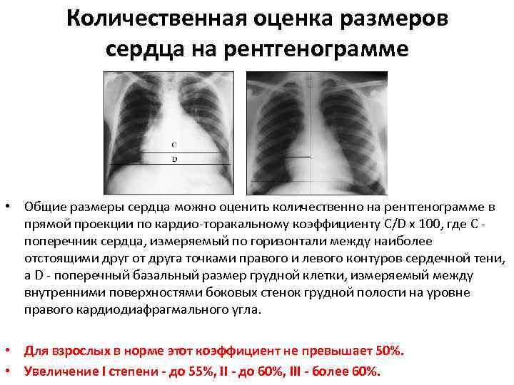 Количественная оценка размеров сердца на рентгенограмме • Общие размеры сердца можно оценить количественно на