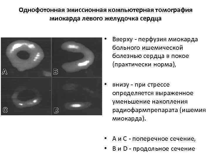 Однофотонная эмиссионная компьютерная томография миокарда левого желудочка сердца • Вверху - перфузия миокарда больного