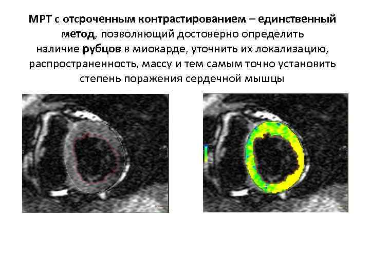 МРТ с отсроченным контрастированием – единственный метод, позволяющий достоверно определить наличие рубцов в миокарде,