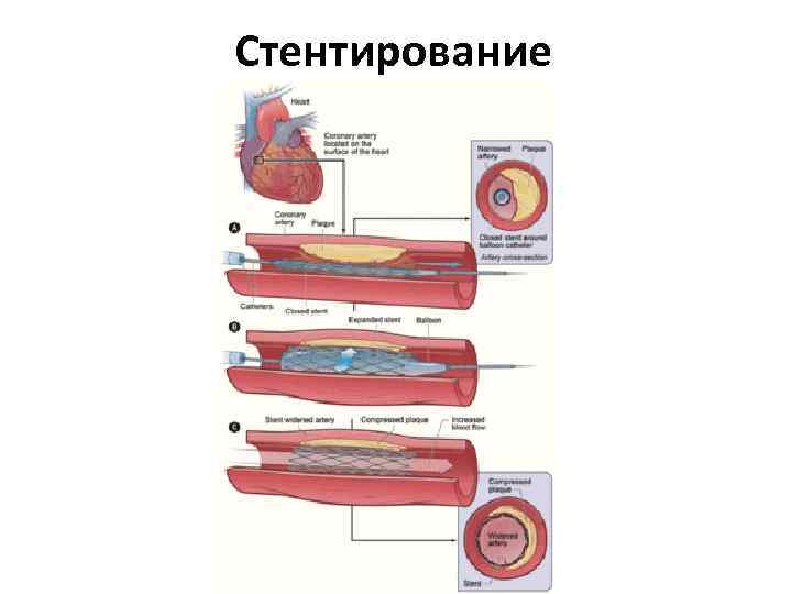 Стентирование 