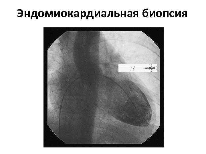 Эндомиокардиальная биопсия 