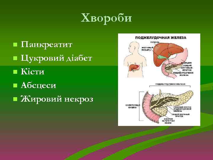Хвороби Панкреатит n Цукровий діабет n Кісти n Абсцеси n Жировий некроз n 