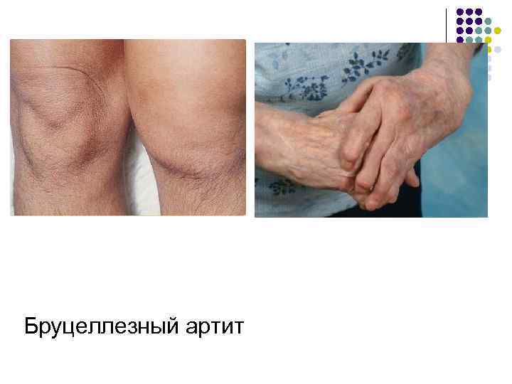 Бруцеллезный артит 