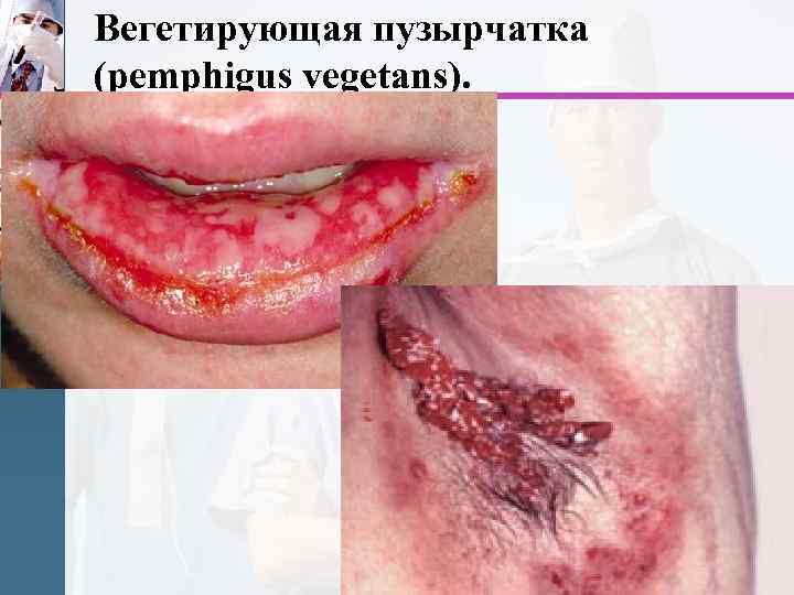 Вегетирующая пузырчатка (pemphigus vegetans). 