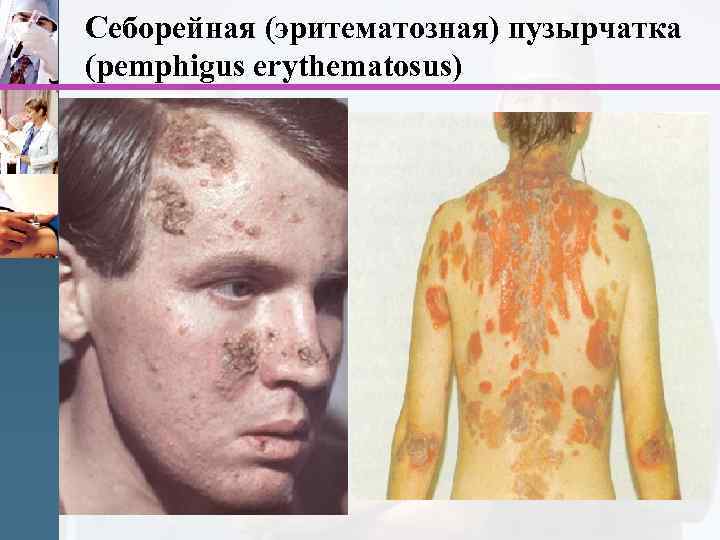 Себорейная (эритематозная) пузырчатка (pemphigus erythematosus) 