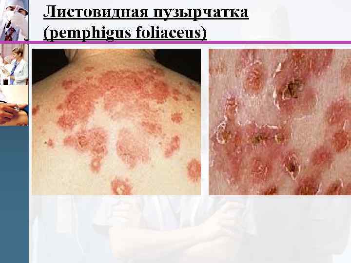 Листовидная пузырчатка (pemphigus foliaceus) 