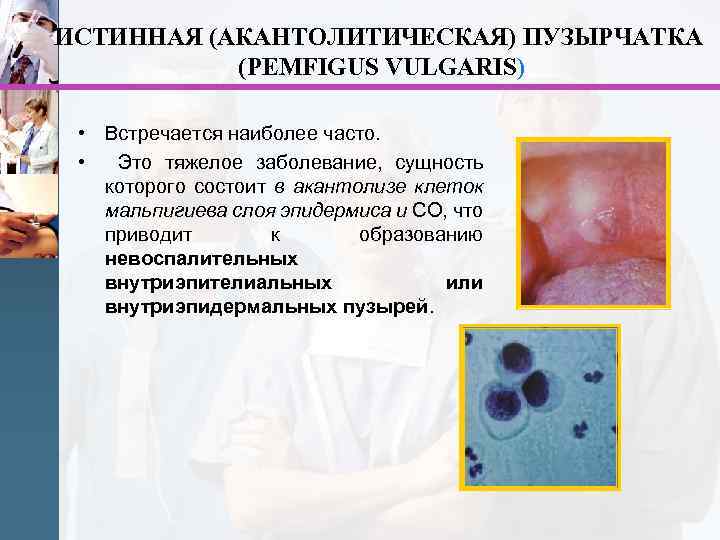 ИСТИННАЯ (АКАНТОЛИТИЧЕСКАЯ) ПУЗЫРЧАТКА (PEMFIGUS VULGARIS) • Встречается наиболее часто. • Это тяжелое заболевание, сущность