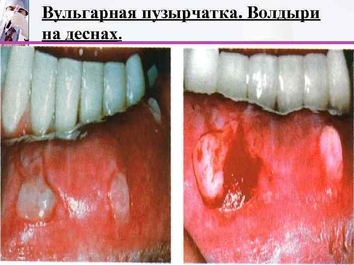 Вульгарная пузырчатка. Волдыри на деснах. 