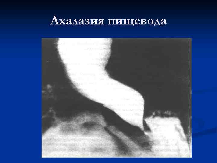 Рентгенологическая картина ахалазии пищевода