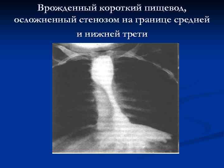 Врожденный короткий пищевод, осложненный стенозом на границе средней и нижней трети 