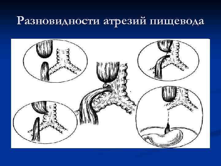 Разновидности атрезий пищевода 