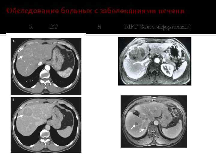 Обследование больных с заболеваниями печени б. КТ и МРТ (более информативны) 
