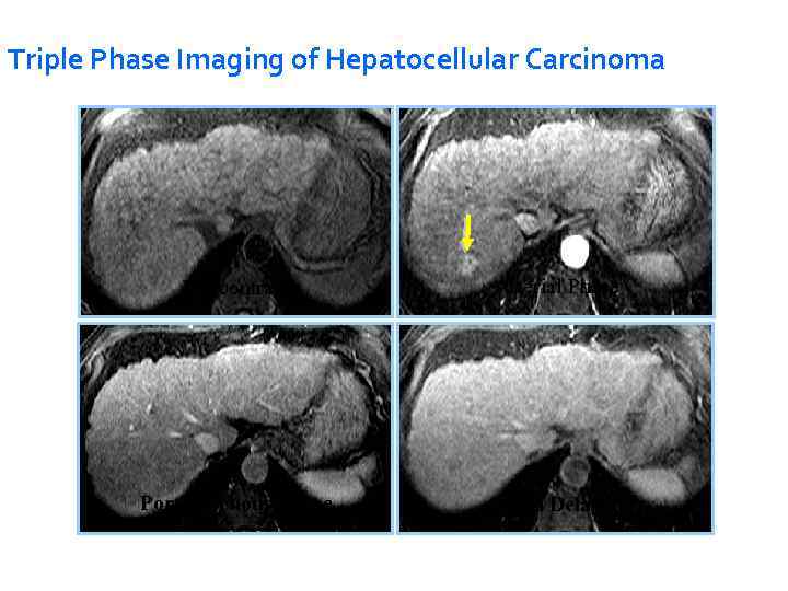 Triple Phase Imaging of Hepatocellular Carcinoma Pre-contrast Arterial Phase Portal Venous Phase 5 -min