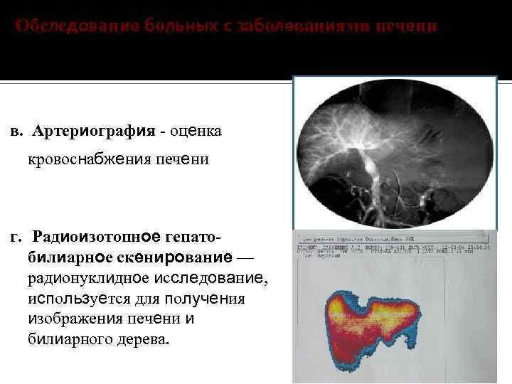 Обследование больных с заболеваниями печени в. Артериография - оценка кровоснабжения печени г. Радиоизотопное гепатобилиарное