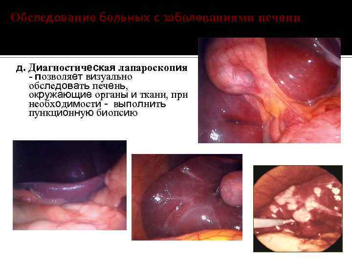 Обследование больных с заболеваниями печени д. Диагностическая лапароскопия - позволяет визуально обследовать печень, окружающие